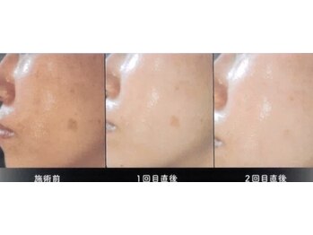 グリーンシャムロック(Green Shamrock)/ダクトピール