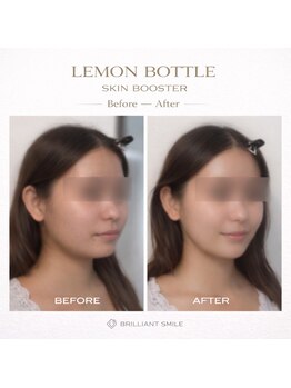 ブリリアントスマイル/レモンボトルスキンブースター