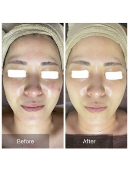 ノルン(Norn)の写真/剥けないハーブピーリングで艶肌へ!毛穴ケア・ニキビケアで理想の美肌に◎通いやすい価格で都度払いOK♪