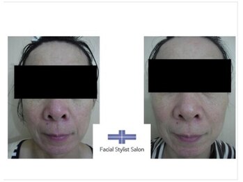 フェイシャルスタイリストサロン 四谷店/ケア例(69)