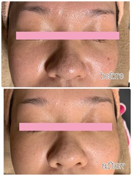 アロマ&クレイケアルーム ネロリドール(Nerolidol)/お鼻の角栓もスッキリ！