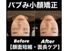 《顔面短縮・面長ケア》日本で唯一バブみ特化小顔矯正￥17,600⇒￥8,800　