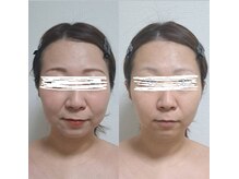 ネマウム(nemaum)/エイジングケアエステ♪