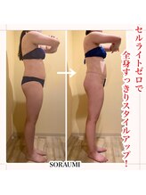 ソラウミ(SORAUMI)/本気痩せ☆痩身セルゼロ6回