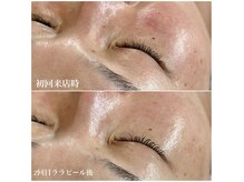 【肌を育てる】ピーリング　乾燥・敏感肌の方にも◎