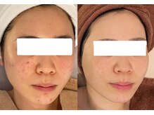 ミベル(MeBell)/ニキビケア/ハーブリプロ