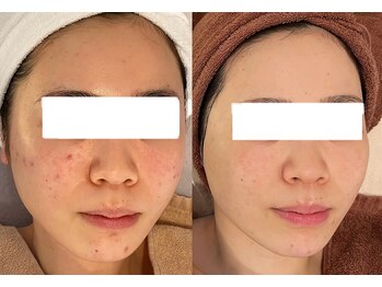 ミベル(MeBell)/ニキビケア/ハーブリプロ