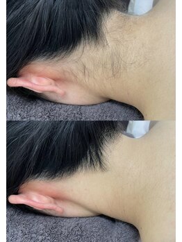 カルディエ(Cardie)/うなじ脱毛　ビフォーアフター