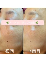 ガーデン(Garden)/ハーブピーリング3