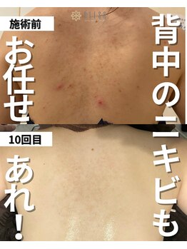 ブレス 天童店(BLESS)/背中ハーブピーリングコース☆