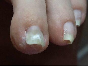 爪切り屋 美磨寿の写真/大人気トータルケア【【爪切り+角質ケア+膝下マッサージ】90分◆足のトラブルを徹底改善！初めての方にも◎