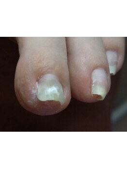 フットケアを受けたい