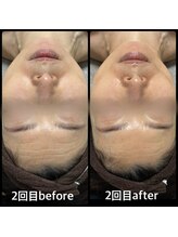 クリアボックス(Clear box)/【ララピール】