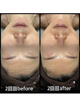 クリアボックス(Clear box)/【ララピール】