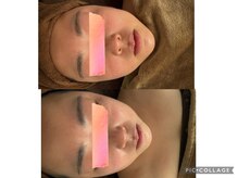 イディアル(IDE'AL)/陶肌ピール