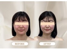 トロワ(TROIS)/継続で戻らない小顔に導く