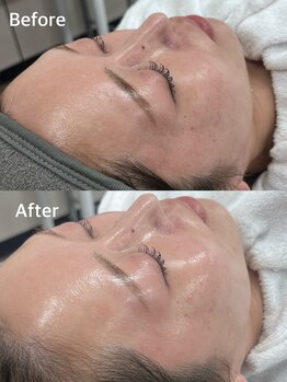 リボンドケー(Rebond-K)の写真/韓国発の次世代ピーリングで、つるんと輝く水光肌へ。毛穴・くすみ・キメを整え、素肌に自信を。