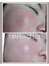 ビーピー 渋谷(b.p.)/赤み、敏感肌　ハーブピーリング