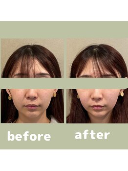 プラス(APLUS)/美容鍼灸　施術前後