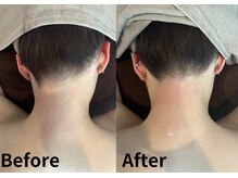 シェール(Cher)/襟足脱毛