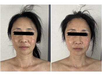 モア(moa)/ほうれい線/リフトケア