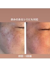 ジュエル(jewel)/低周波シミケア