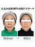 【強制的小顔肌質改善】徹底的に肌を磨きます◎(60分)￥19,800→￥15,400　