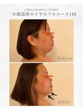 ルミア(LUMIA)/小顔造形ロイヤルフルコース１回