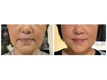 ねこのひげ/お顔の変化