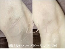 ヴィーダ 渋谷松濤(ViDA)/脇の黒ずみ/ポツポツ毛穴改善