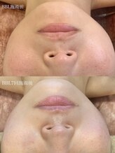 ベル(Belle)/BBLフェイシャル