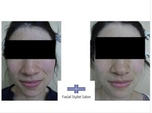 フェイシャルスタイリストサロン 四谷店/ケア例（71）