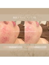 ルナージュ(LUNARJE)/陶肌トリートメント 肌質改善