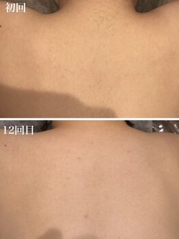 ウルル 上野店(ULULU)/背中の毛穴ケア