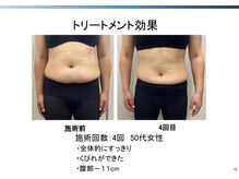 トラレス(Trouless)/脂肪冷却