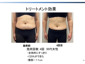 トラレス(Trouless)/脂肪冷却