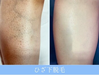オーシャンブルー 長崎店(OCEAN BLUE)/結果が出る脱毛!ヒザ下脱毛