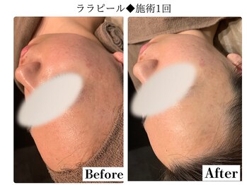 フレイヤ(FREYA)/ララピールBefore→After