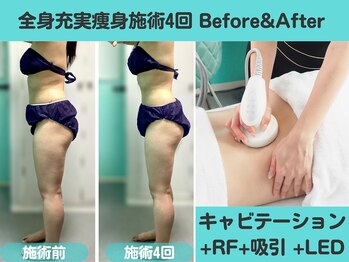 ナナ 銀座(Nana)/腰回り+太もものセル脂肪分解