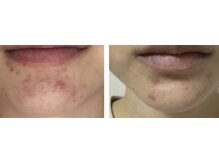 サロン リノ(salon rino)の雰囲気（繰り返すニキビにはララピールとララショットのダブルケア◎）