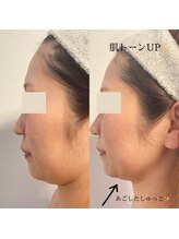 ひっそり美肌構築/ブライダルのお客様♪