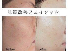 ユニクリア(Uni clear)/ハーブピーリング/プラズマ