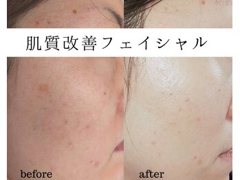 ユニクリア(Uni clear)/ハーブピーリング/プラズマ