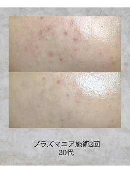 コンクパール(CONCH PEARL.)/プラズマニア