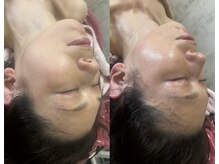 マホロバ(mahoroba)/美容鍼×ハーブピーリング