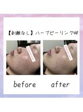 シャルム ココ 八尾店(Charme coco)/剥離なしのハーブピーリング！