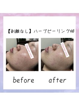 シャルム ココ 八尾店(Charme coco)/剥離なしのハーブピーリング！