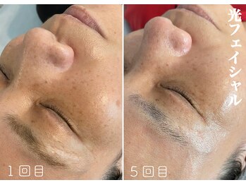 モノ(MONO)/【光フェイシャル】