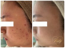 リリー(Rily)/【肌改善専門サロン】