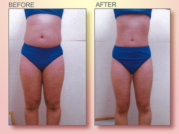 ジュリア オージェ 梅田店/ビフォーアフター(脂肪燃焼)